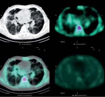 ОФЭКТ / КТ в сочетании с флуоресцентной визуализацией выявляют микрометастазы: двойная визуализация может помочь в хирургии рака