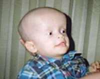 Детская гидроцефалия: опубликованы рекомендации по лечению